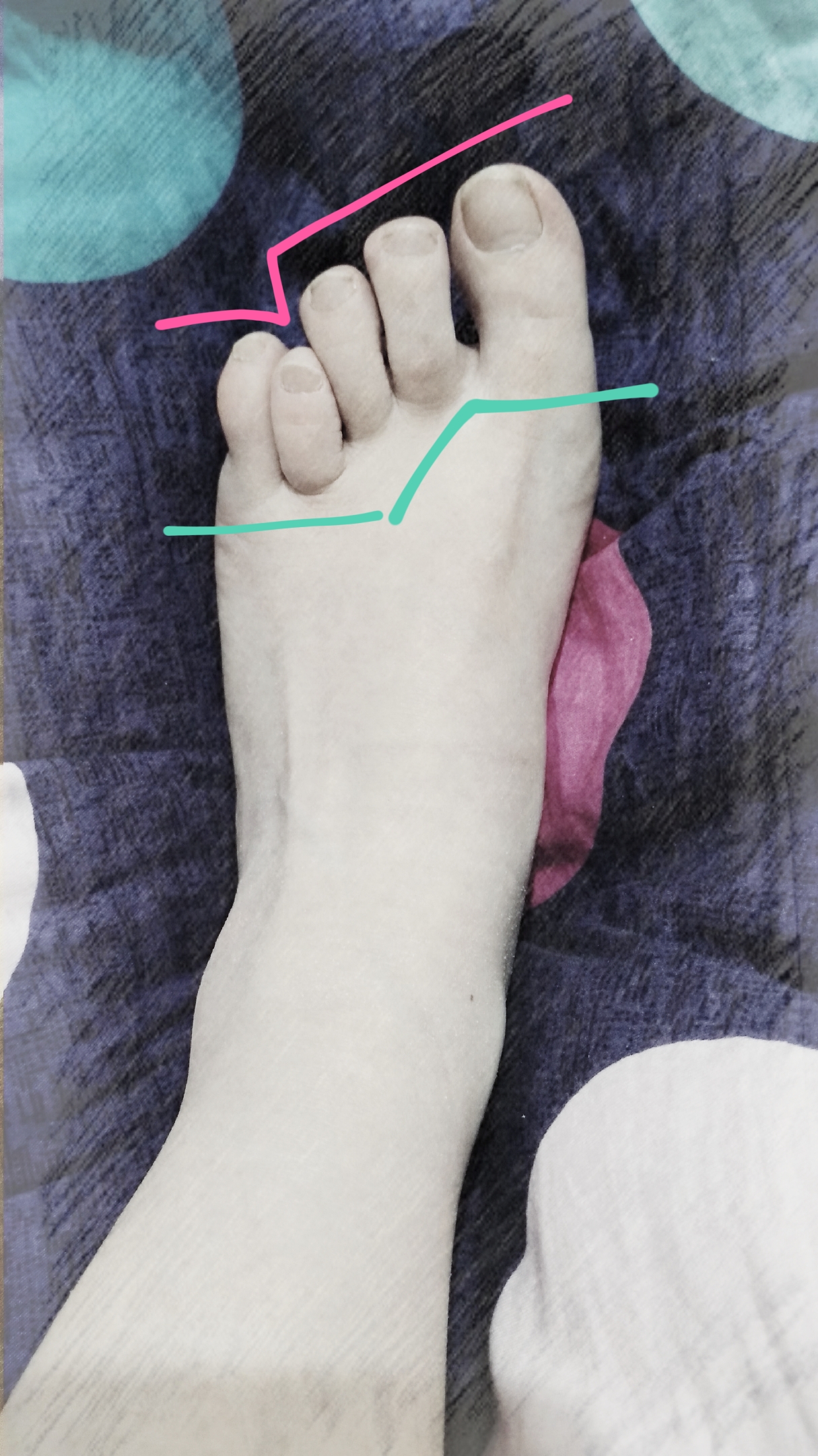作为一个女生，脚拇指外翻是一种怎样的体验？ - 知乎