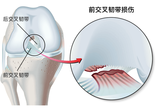 膝关节前交叉韧带结构图